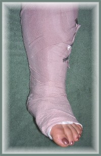 Brooksyne's broken ankle