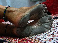 Calloused feet